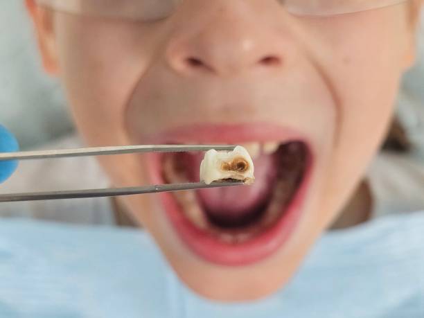 Best Chipped Tooth Repair Near Me  in Lakeside, OR